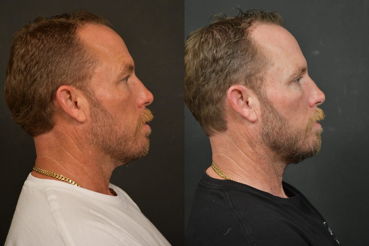 Male Eyelid Procedures Before & After Gallery - Patient 136558 - Image 3