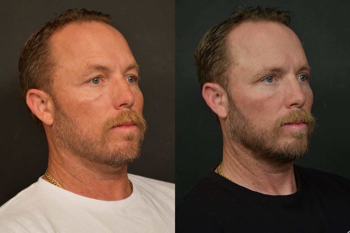 Male Eyelid Procedures Before & After Gallery - Patient 136558 - Image 2