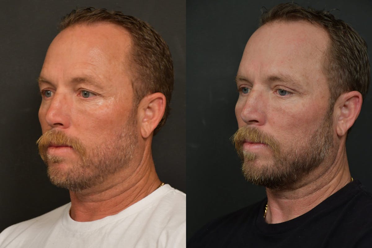Male Eyelid Procedures Before & After Gallery - Patient 136558 - Image 4