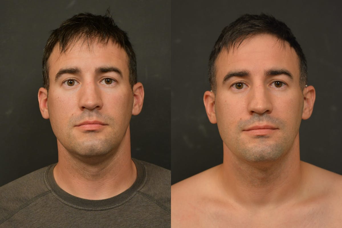 Male Face Liposuction Before & After Gallery - Patient 328596 - Image 1