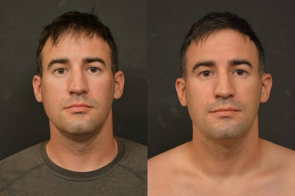 Male Face Liposuction Before & After Gallery - Patient 328596 - Image 1