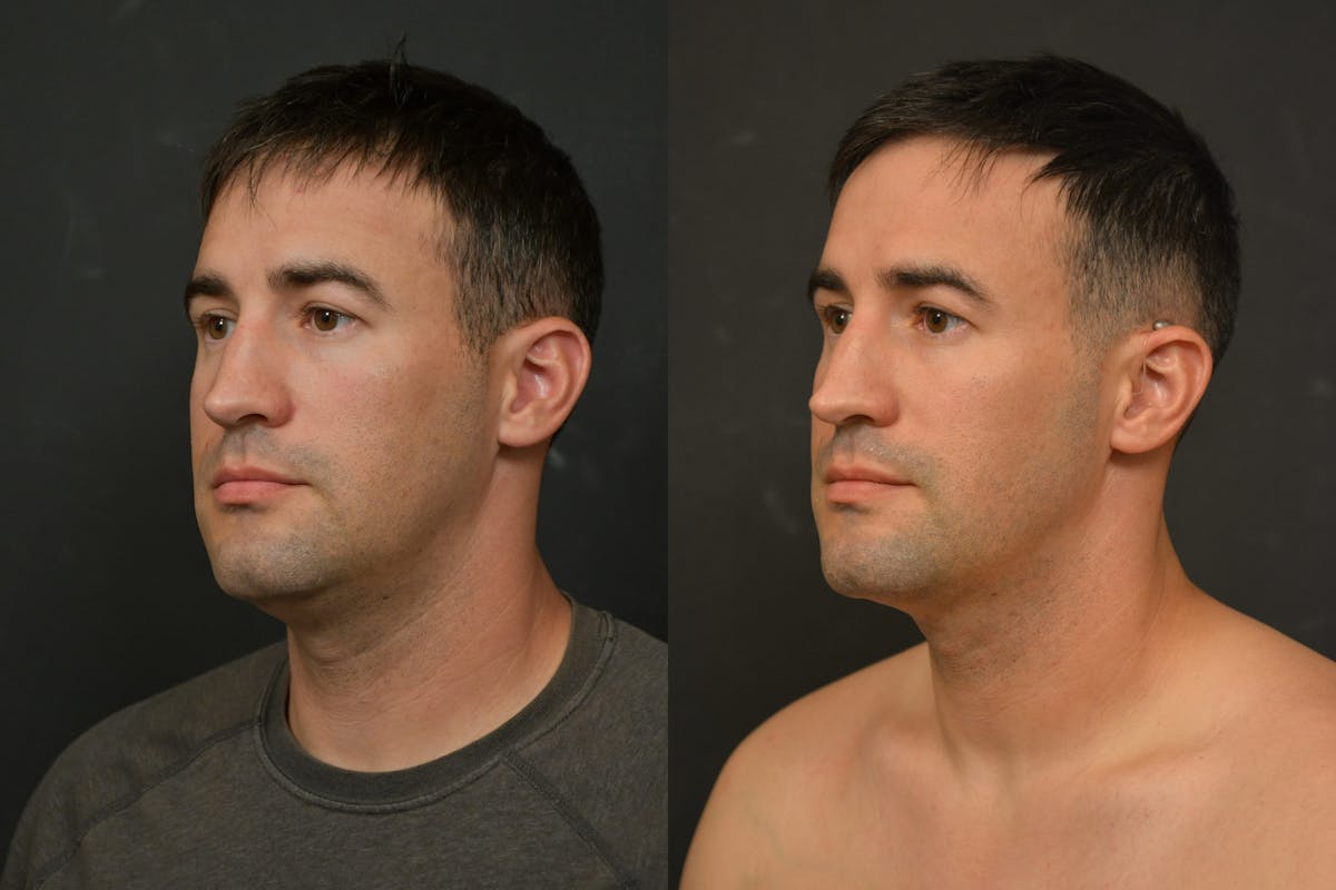 Male Face Liposuction Before & After Gallery - Patient 328596 - Image 2