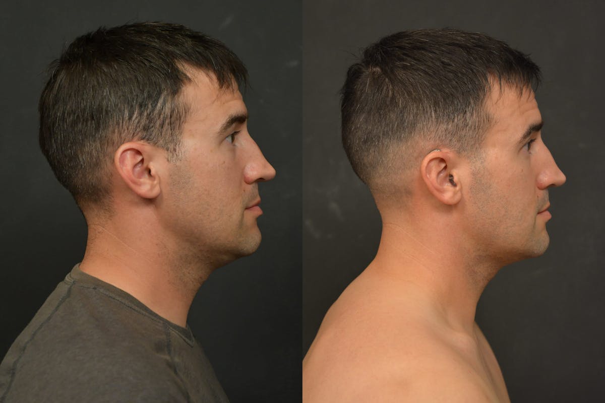Male Face Liposuction Before & After Gallery - Patient 328596 - Image 3