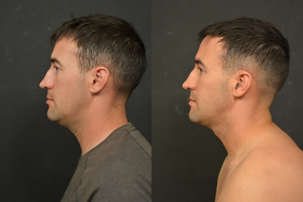 Male Face Liposuction Before & After Gallery - Patient 328596 - Image 5