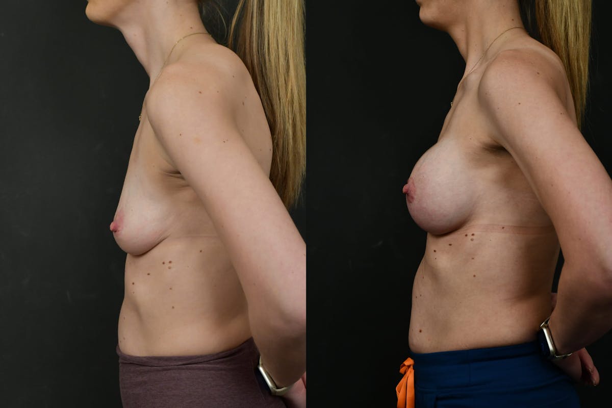 Breast Augmentation Before & After Gallery - Patient 140002 - Image 5
