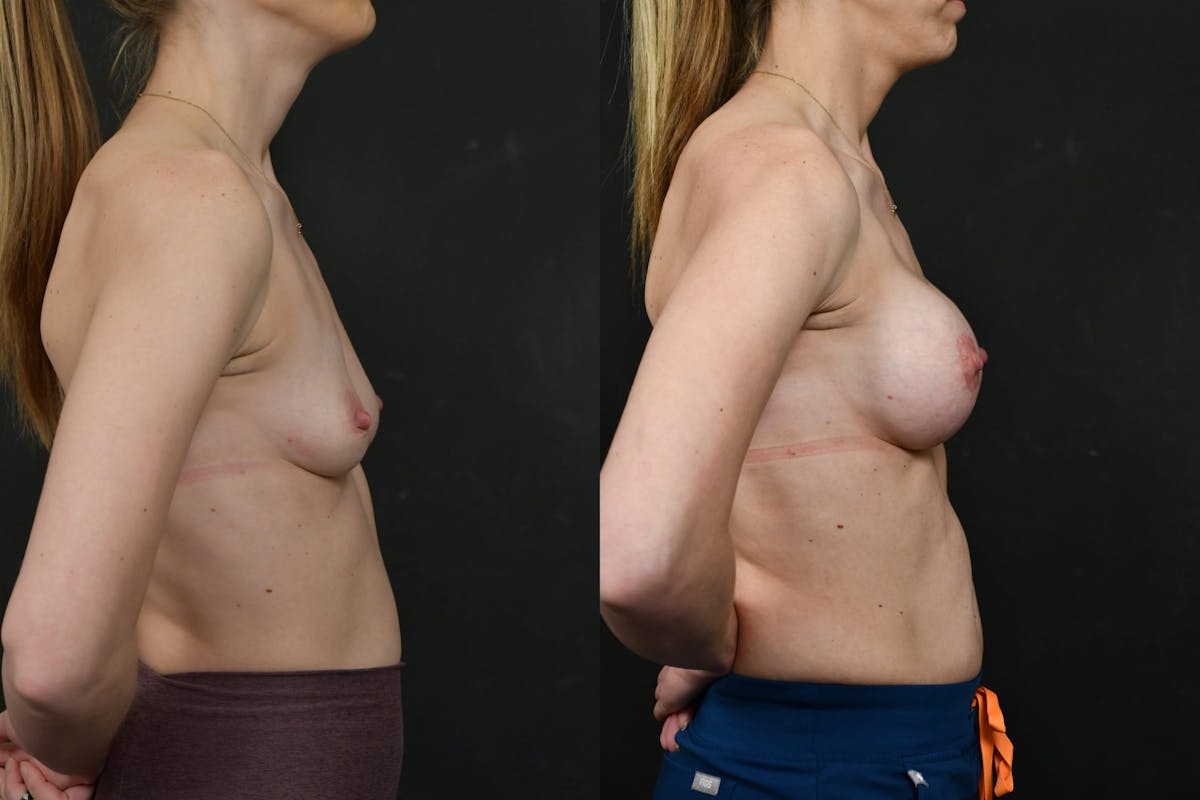 Breast Augmentation Before & After Gallery - Patient 140002 - Image 3