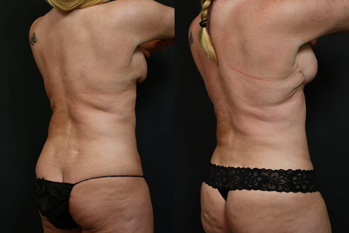 Reverse Tummy Tuck Before & After Gallery - Patient 215932 - Image 2