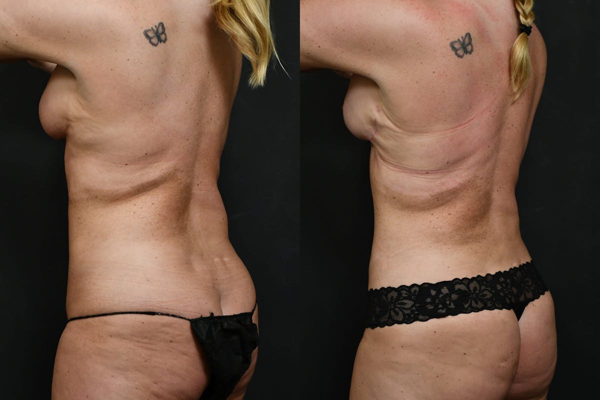 Reverse Tummy Tuck Before & After Gallery - Patient 215932 - Image 3