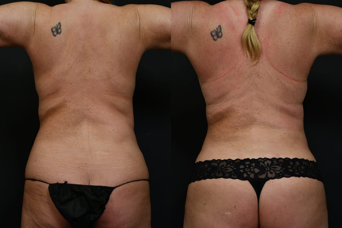 Reverse Tummy Tuck Before & After Gallery - Patient 215932 - Image 4