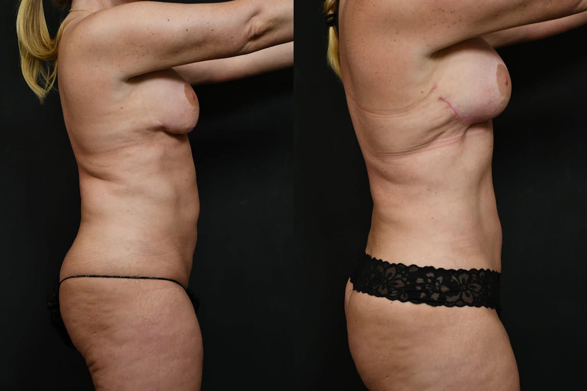 Reverse Tummy Tuck Before & After Gallery - Patient 215932 - Image 6