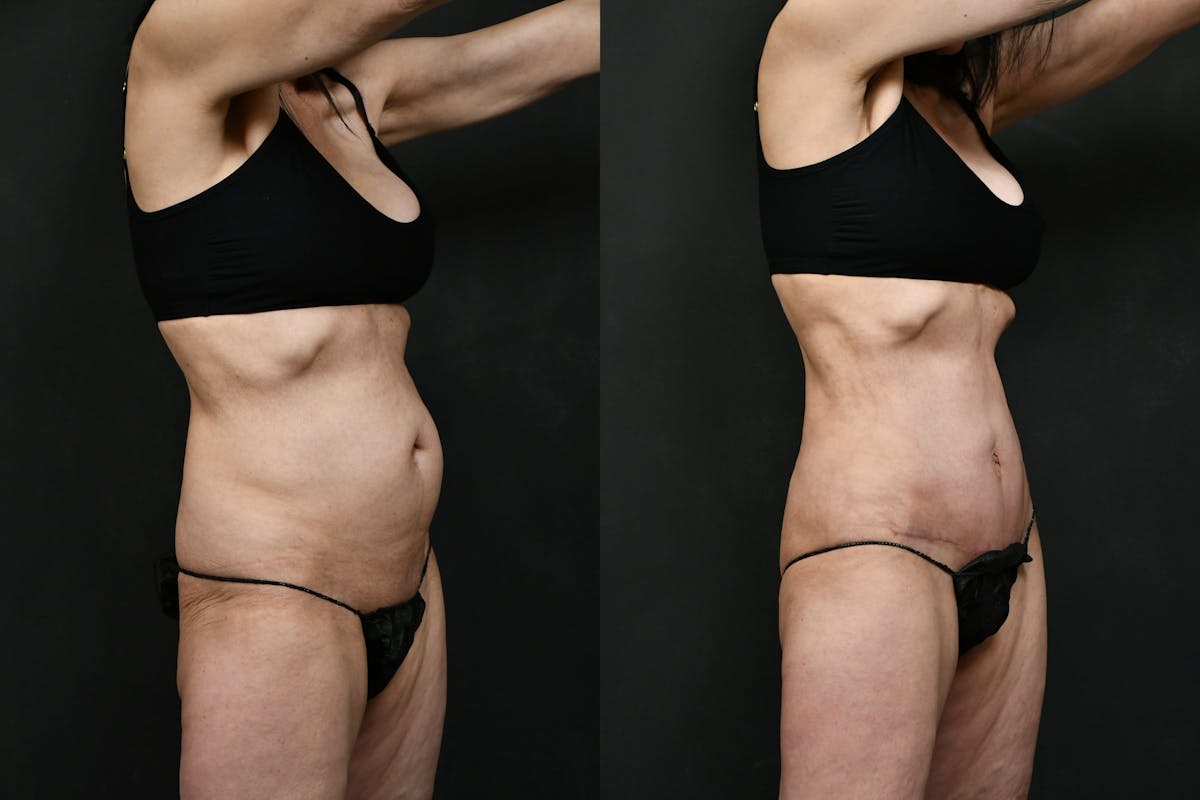 Mini Tummy Tuck (Tunneled) Before & After Gallery - Patient 381641 - Image 2