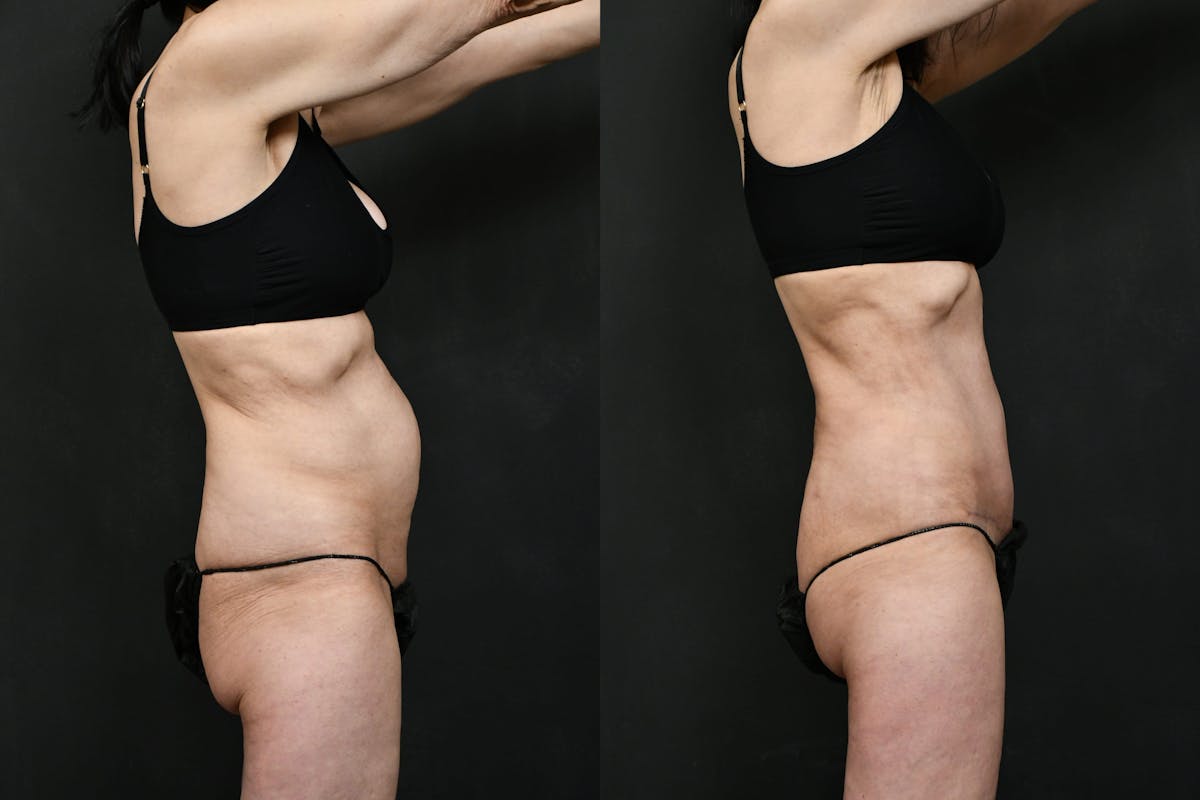 Mini Tummy Tuck (Tunneled) Before & After Gallery - Patient 381641 - Image 3