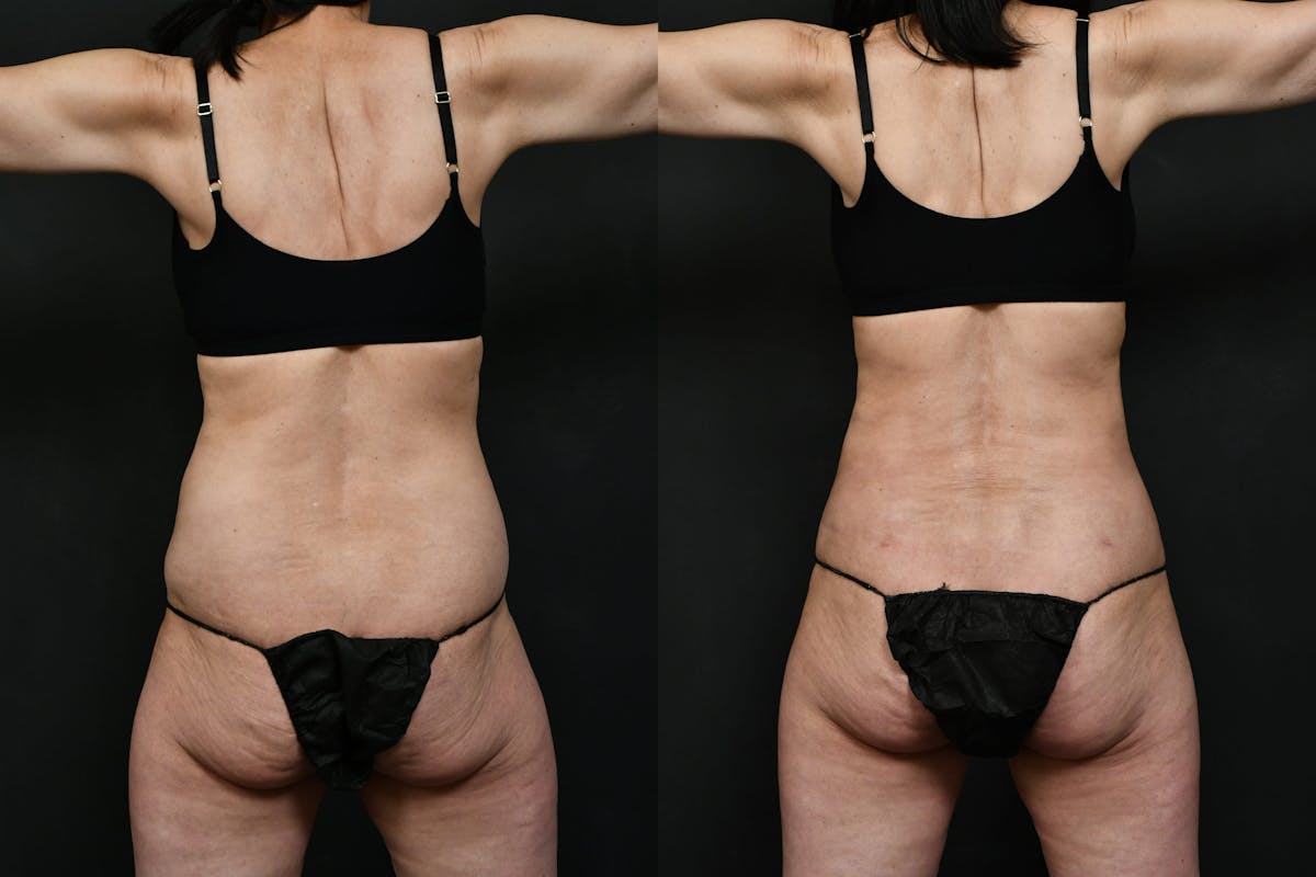 Mini Tummy Tuck (Tunneled) Before & After Gallery - Patient 381641 - Image 4