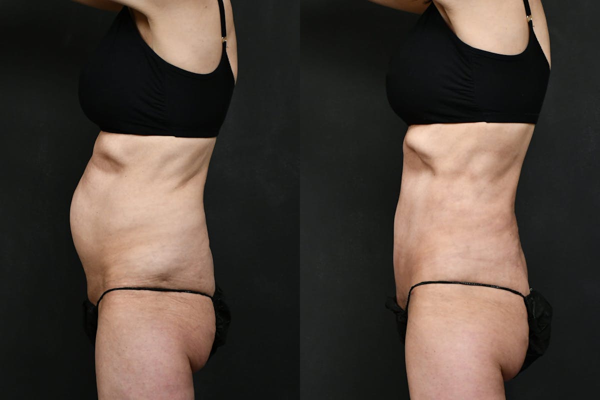Mini Tummy Tuck (Tunneled) Before & After Gallery - Patient 381641 - Image 5