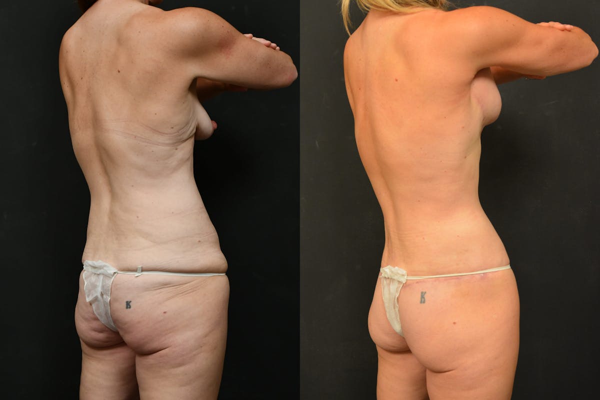 Mommy Makeover Before & After Gallery - Patient 115526 - Image 5