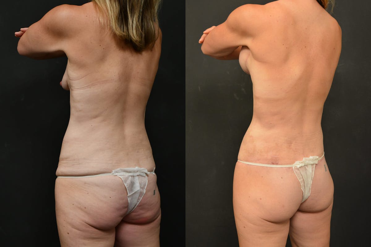 Mommy Makeover Before & After Gallery - Patient 115526 - Image 7