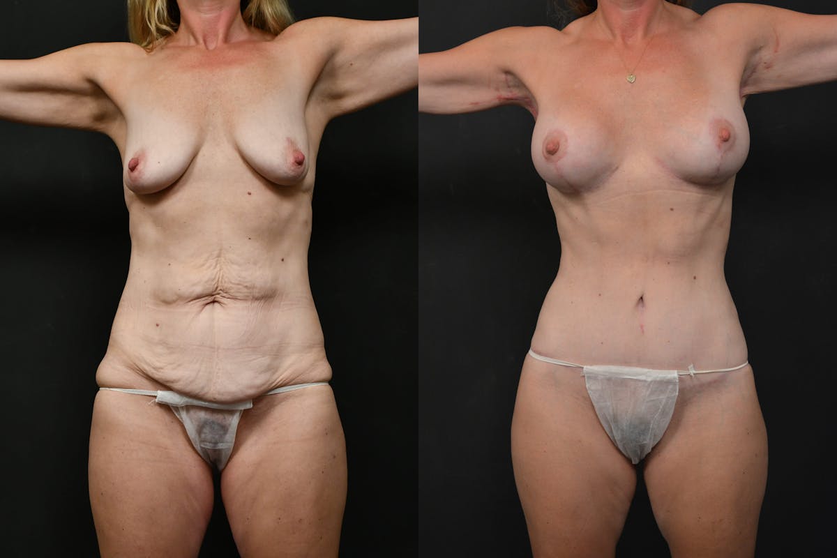 Massive Weight Loss Before & After Gallery - Patient 390908 - Image 6