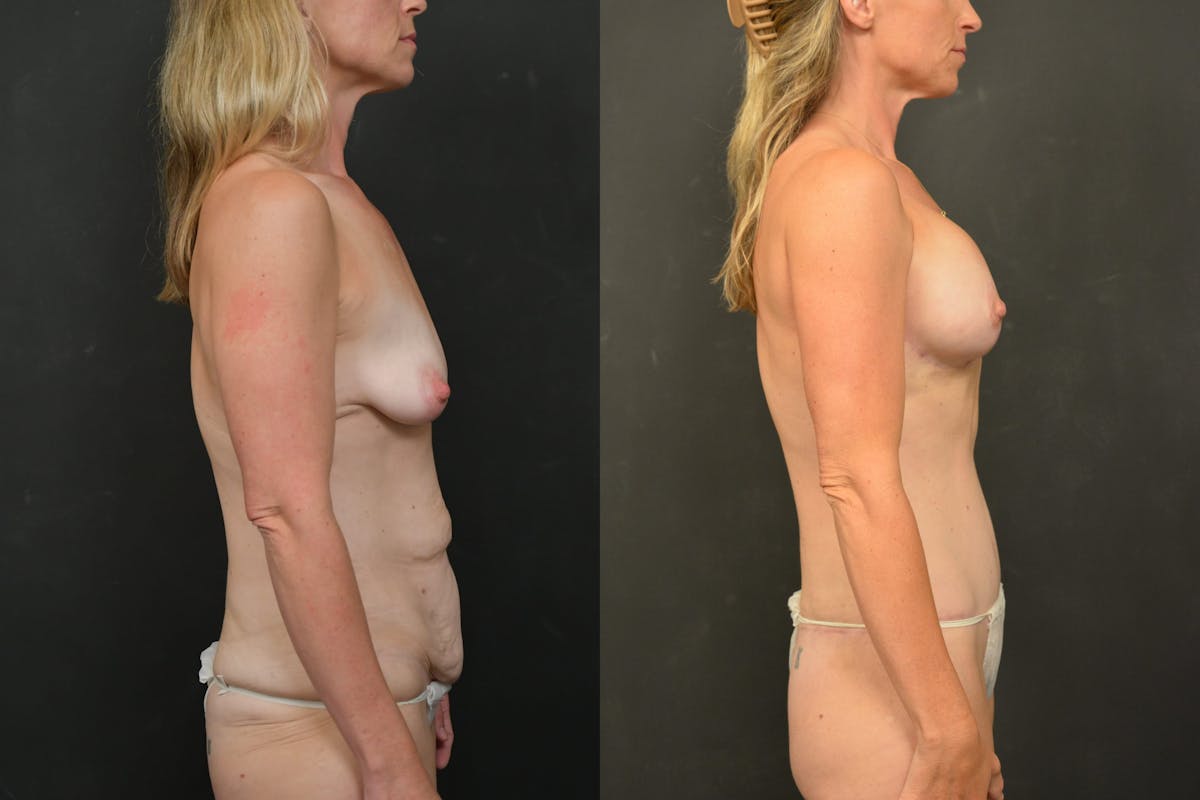 Mommy Makeover Before & After Gallery - Patient 115526 - Image 10