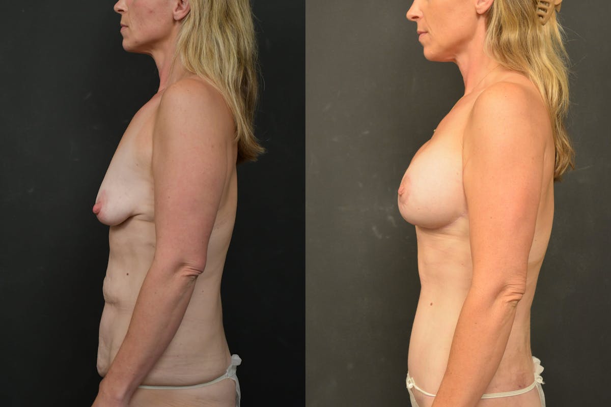 Mommy Makeover Before & After Gallery - Patient 115526 - Image 12