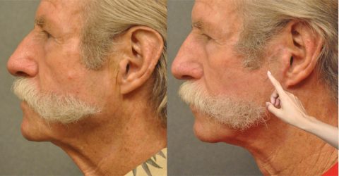 Man with some scarring next to sideburn