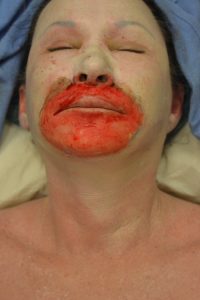 woman undergoing Dermabrasion