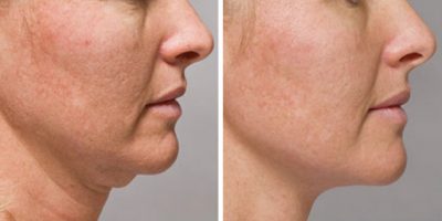 before and after kybella