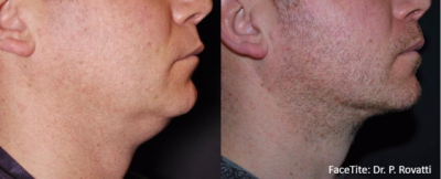 Before and After RFAL