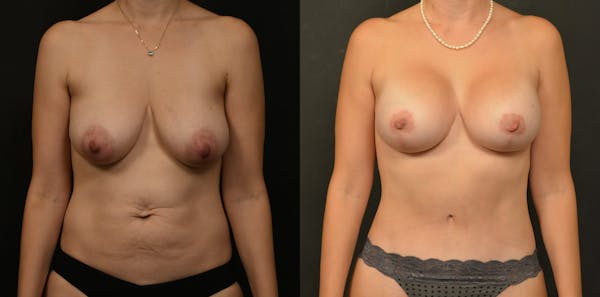 Breast Lift Before & After Gallery - Patient 319269 - Image 1