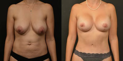 Breast Lift Before & After Gallery - Patient 319269 - Image 1