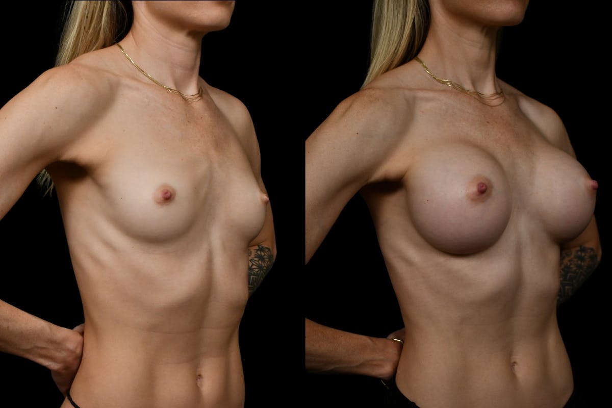 Breast Augmentation Before & After Gallery - Patient 276245 - Image 2