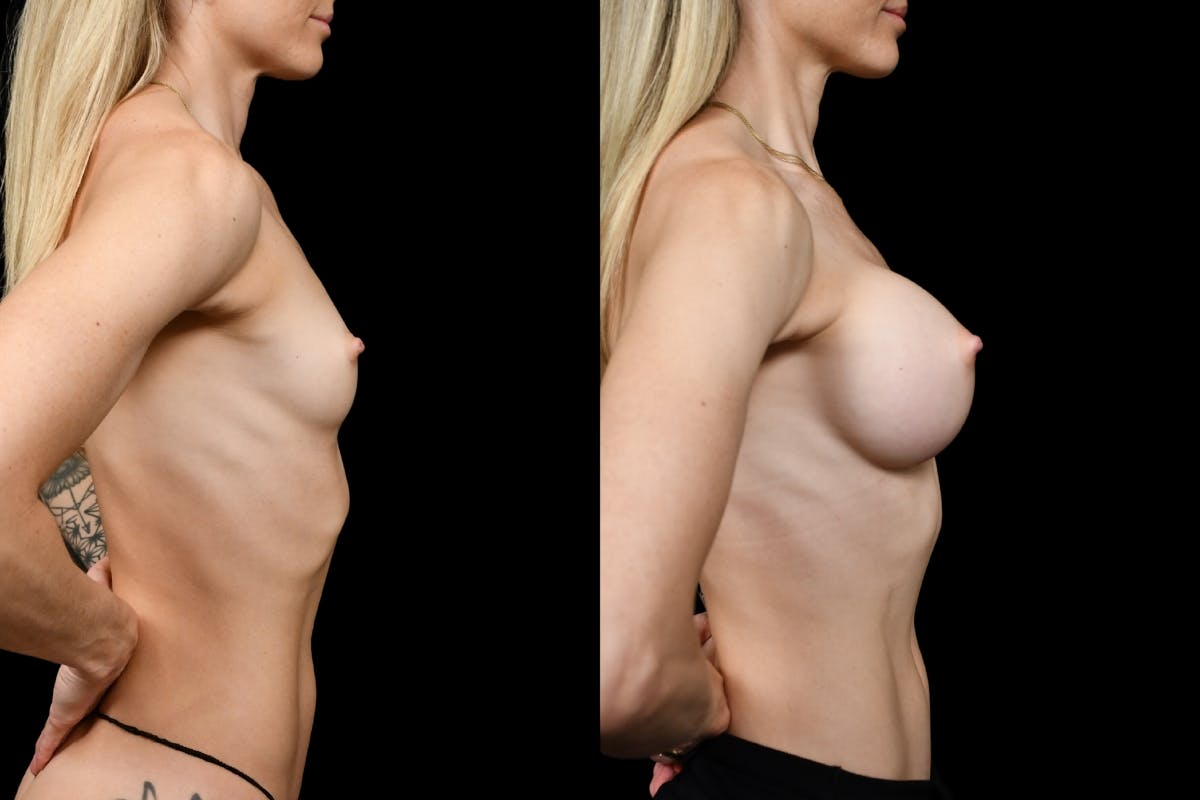 Breast Augmentation Before & After Gallery - Patient 276245 - Image 3