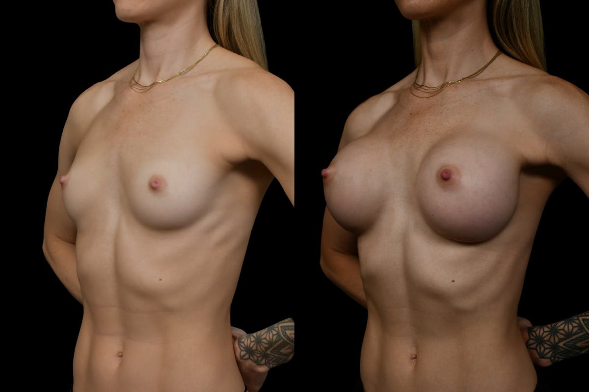 Breast Augmentation Before & After Gallery - Patient 276245 - Image 4