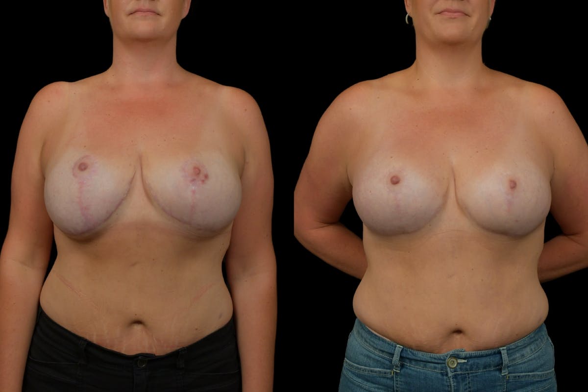 Breast Revision Before & After Gallery - Patient 269314 - Image 1