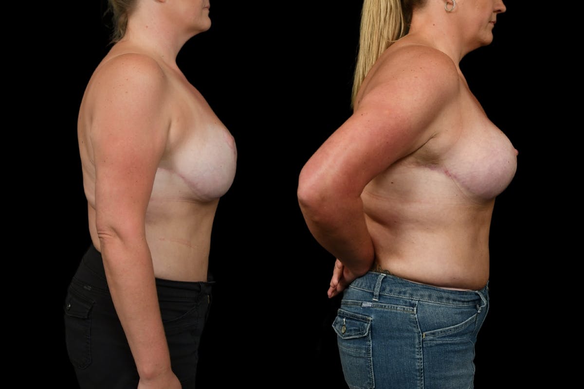 Breast Revision Before & After Gallery - Patient 269314 - Image 3