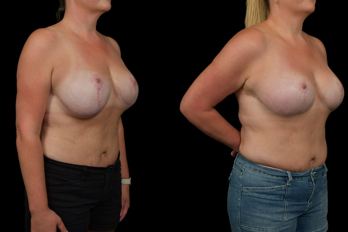 Breast Revision Before & After Gallery - Patient 269314 - Image 2