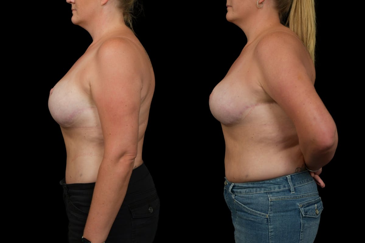 Breast Revision Before & After Gallery - Patient 269314 - Image 5