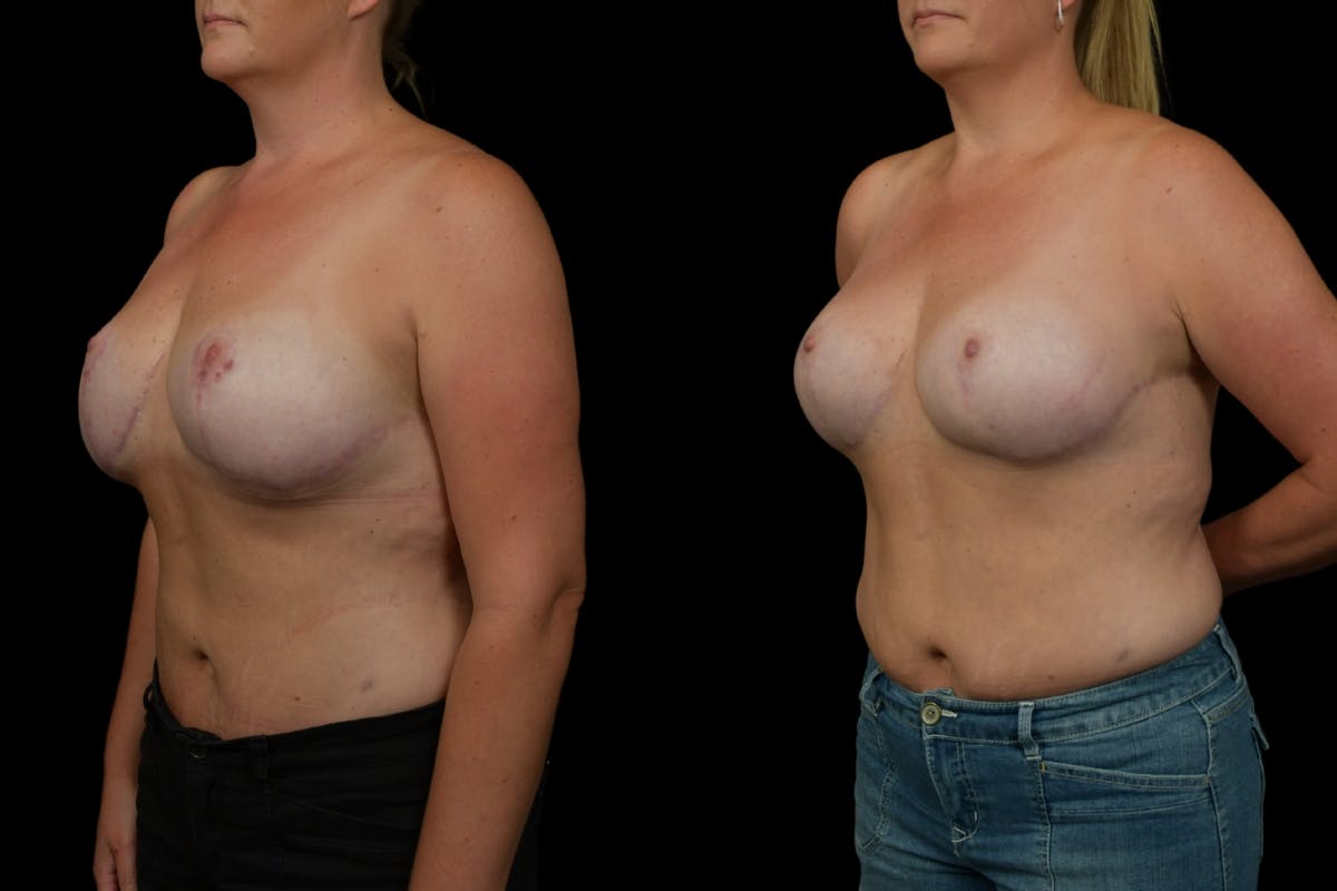 Breast Revision Before & After Gallery - Patient 269314 - Image 4