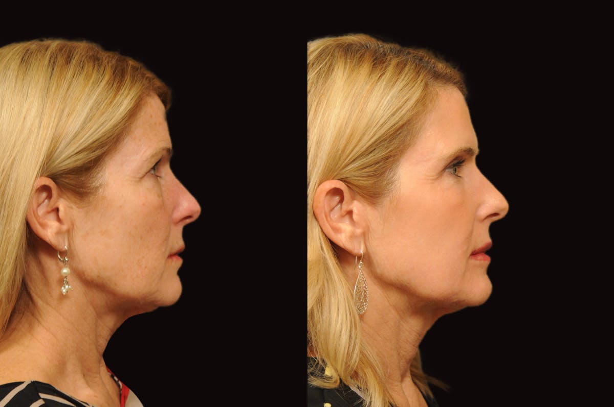 Lasers Before & After Gallery - Patient 356328 - Image 2