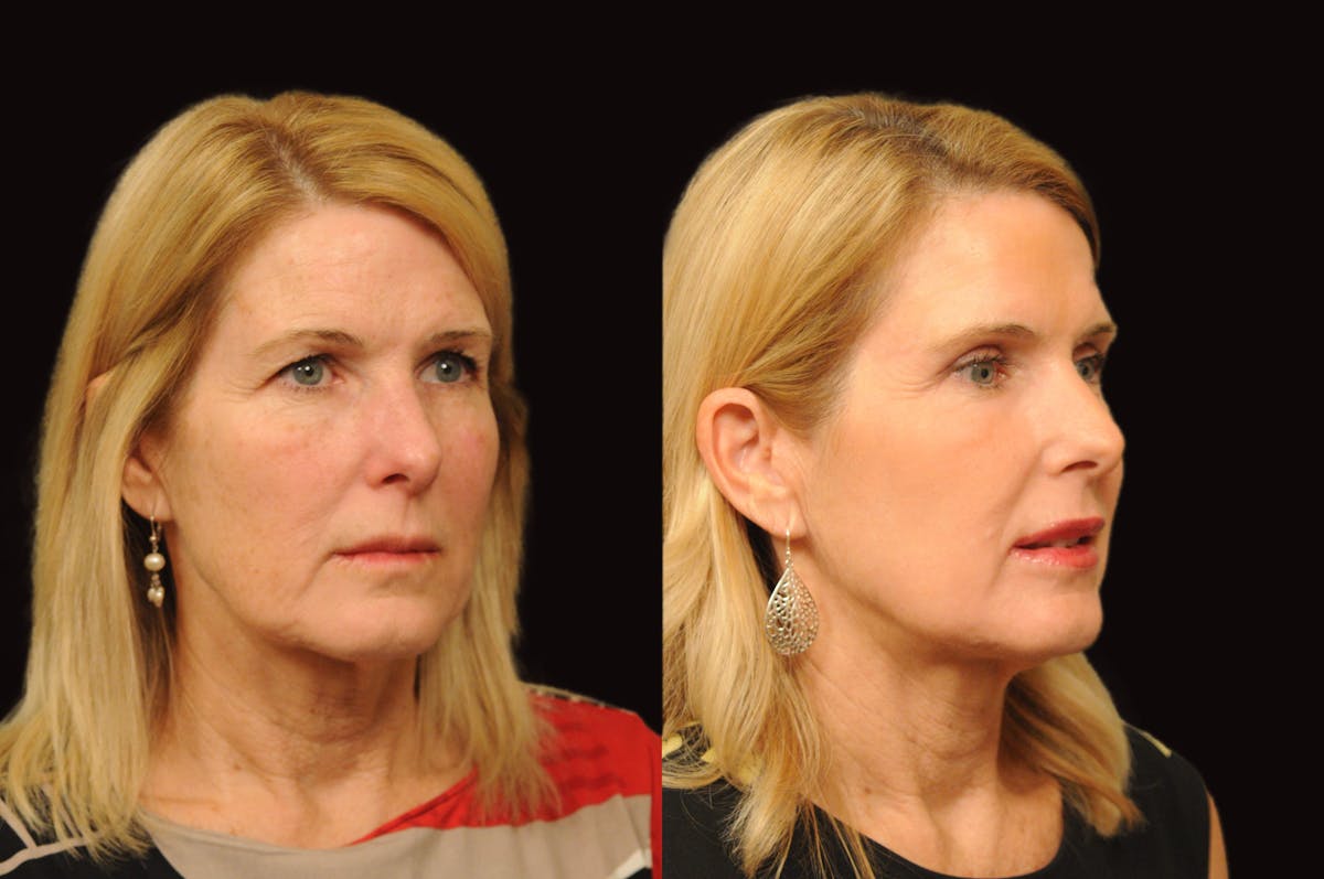Lasers Before & After Gallery - Patient 356328 - Image 3