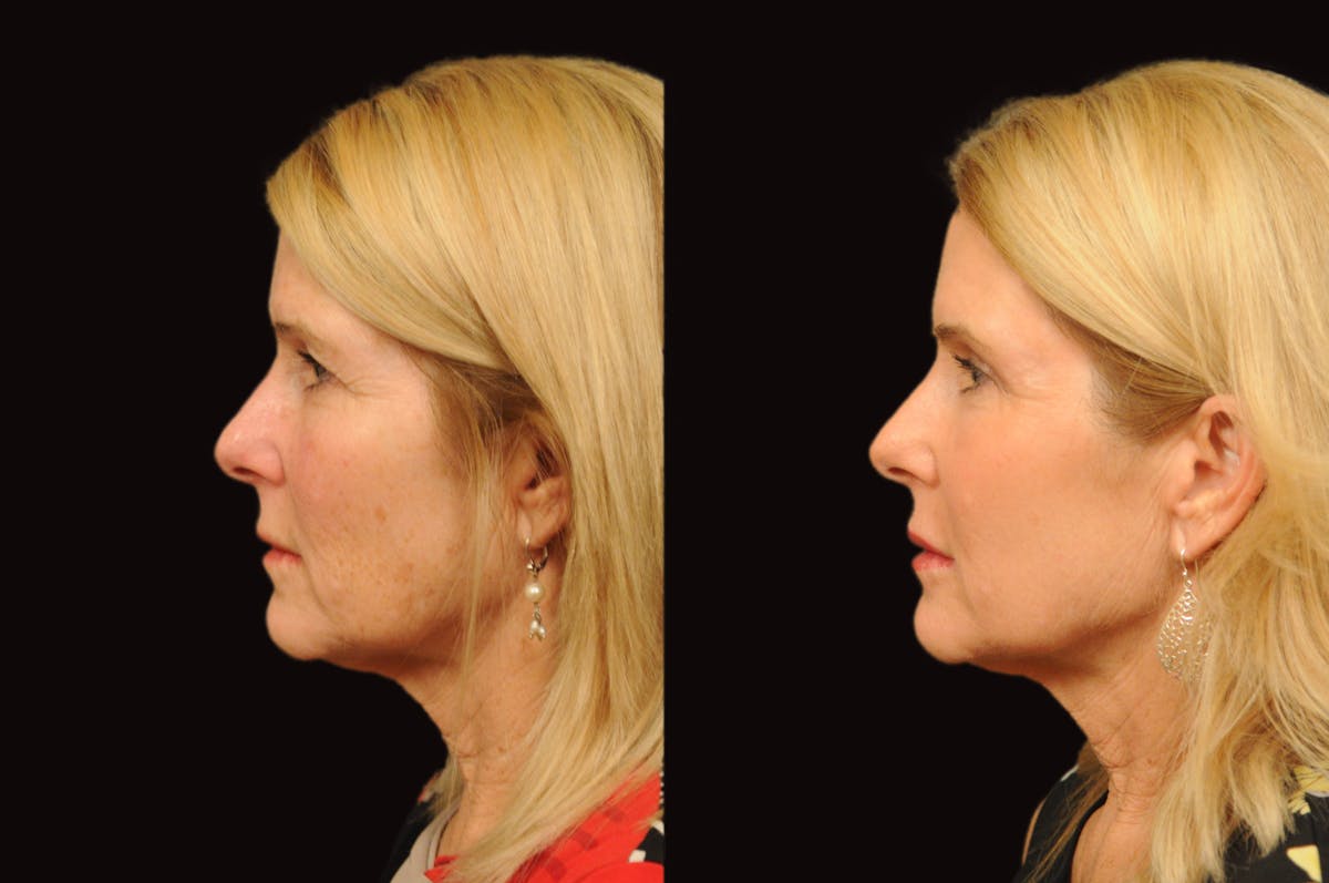 Lasers Before & After Gallery - Patient 356328 - Image 4