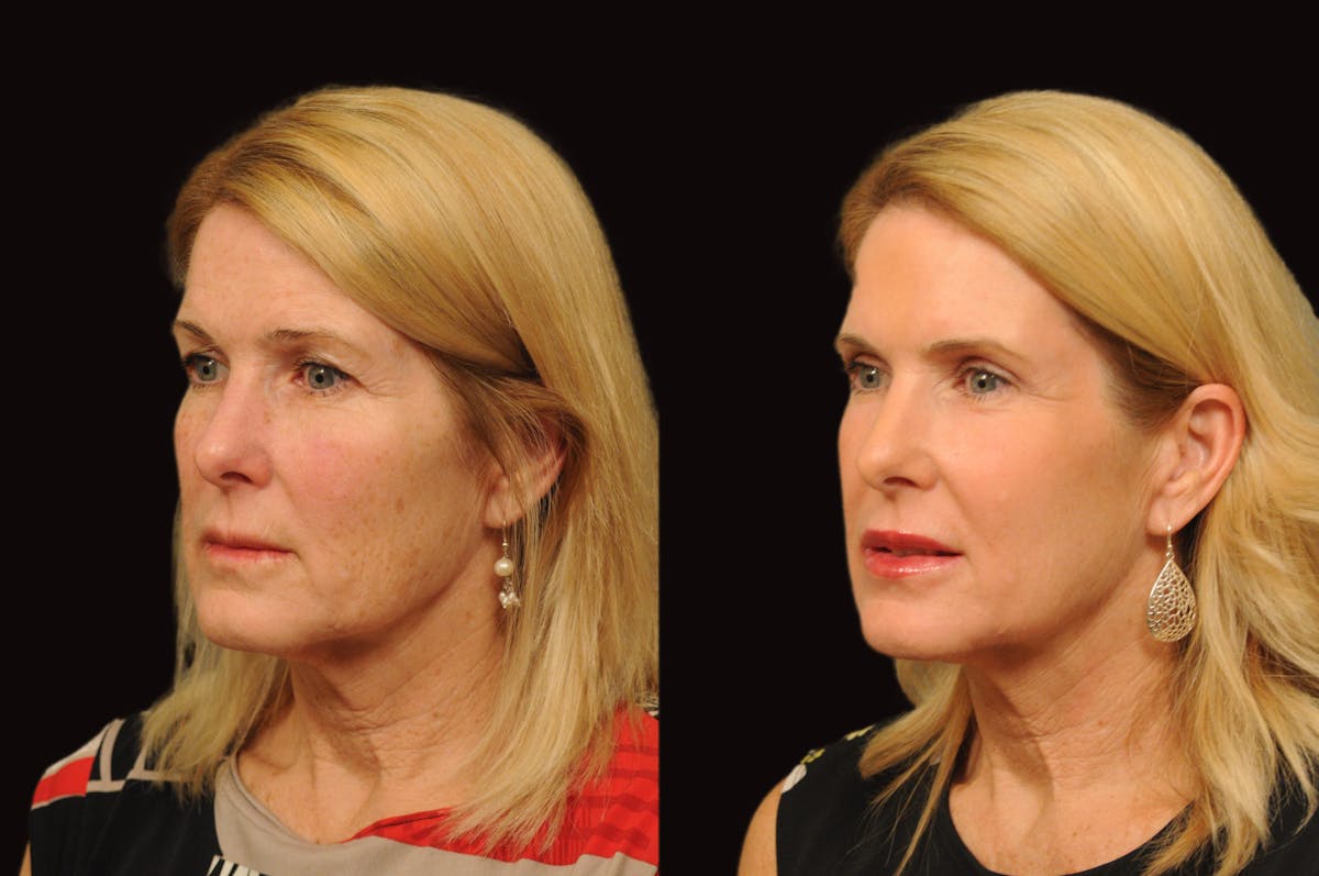 Lasers Before & After Gallery - Patient 356328 - Image 1