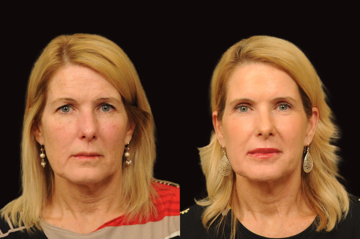 Lasers Before & After Gallery - Patient 356328 - Image 5