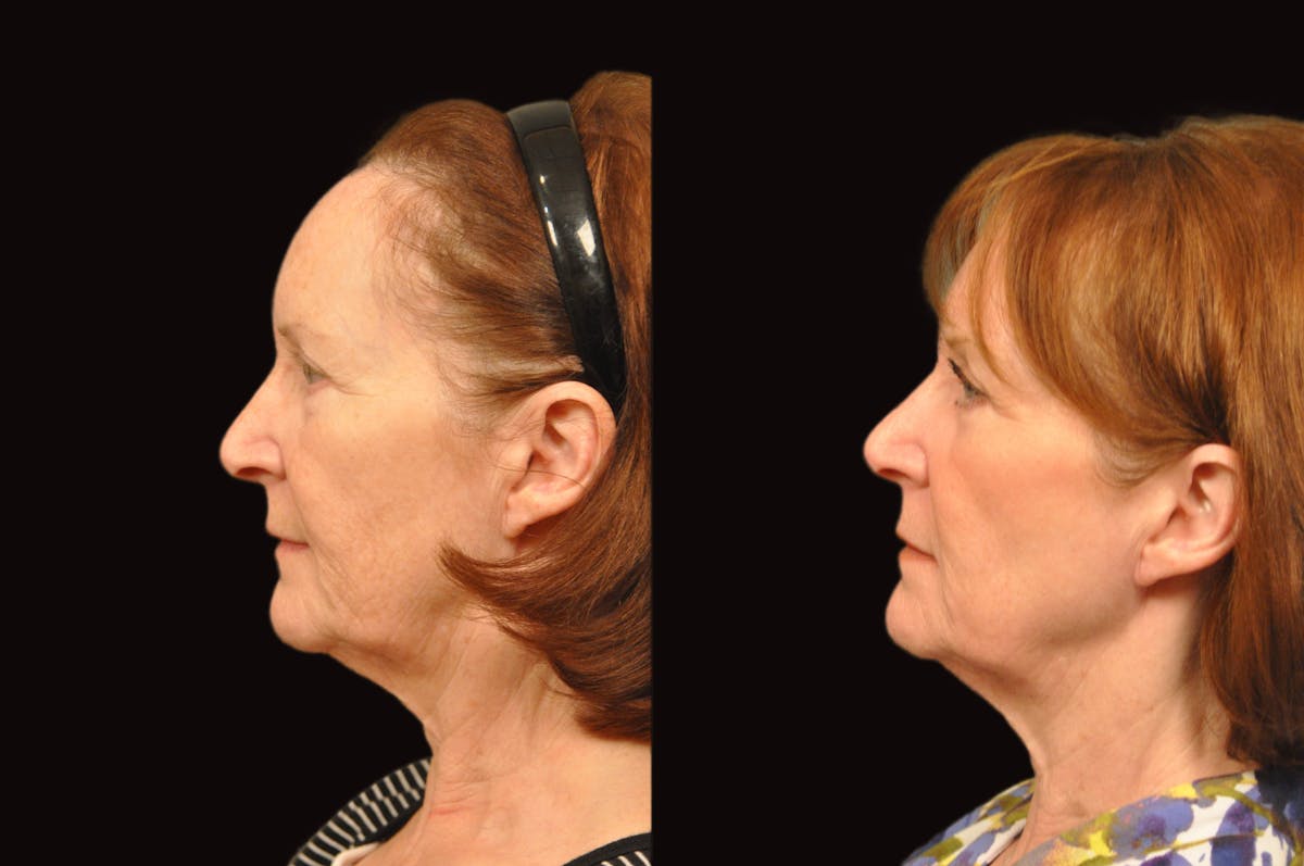 Lasers Before & After Gallery - Patient 213151 - Image 2