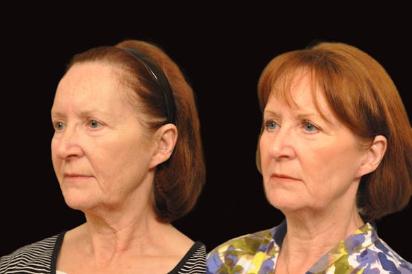 Lasers Before & After Gallery - Patient 213151 - Image 1