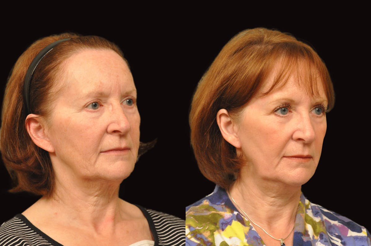 Lasers Before & After Gallery - Patient 213151 - Image 4