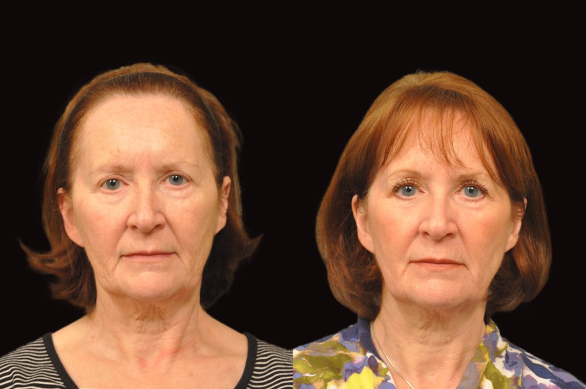 Lasers Before & After Gallery - Patient 213151 - Image 5