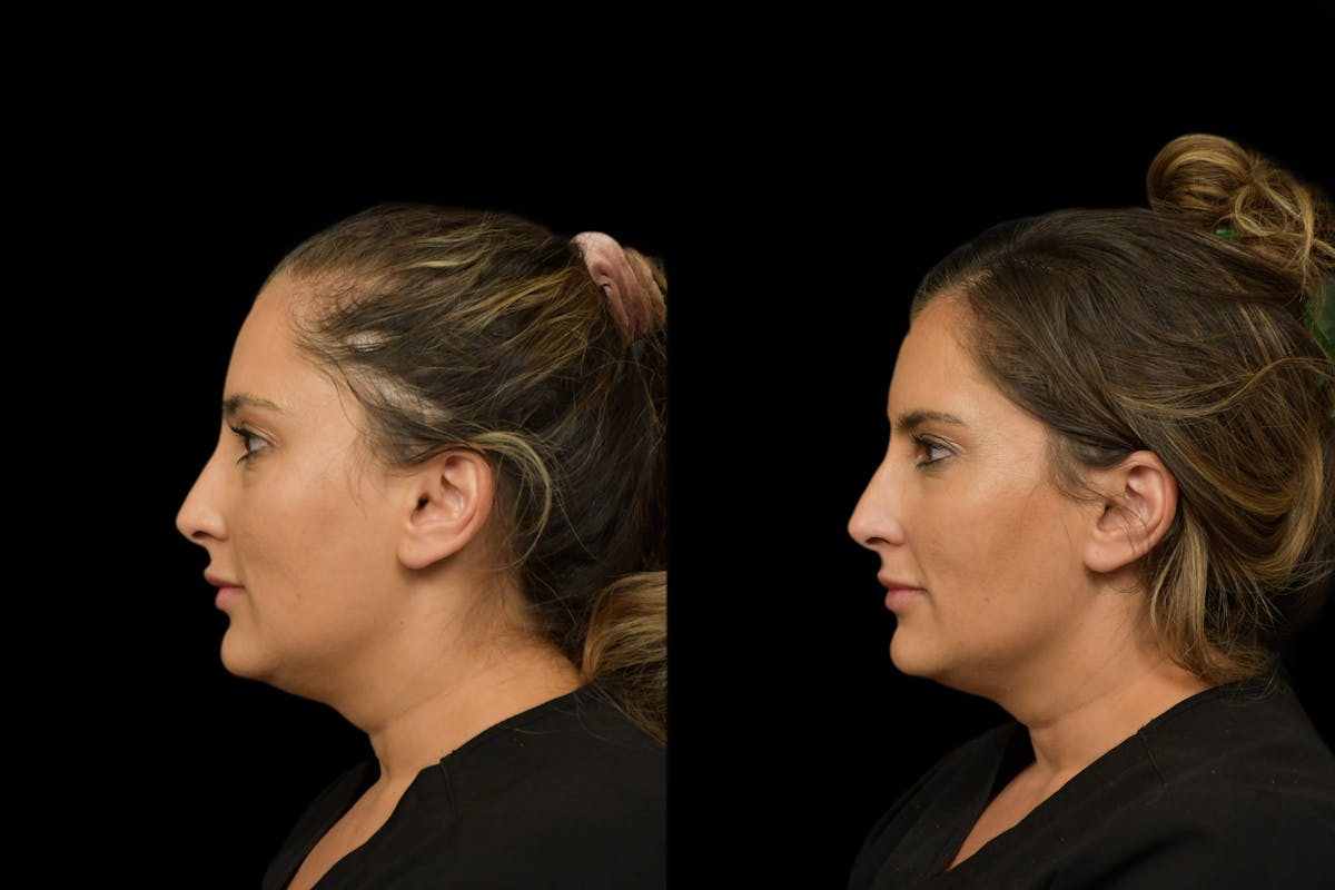 Under Eyes Before & After Gallery - Patient 129403 - Image 2