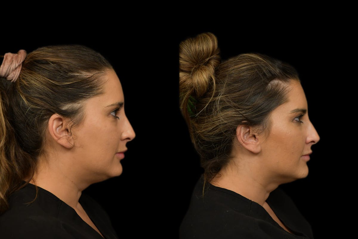 Under Eyes Before & After Gallery - Patient 129403 - Image 4