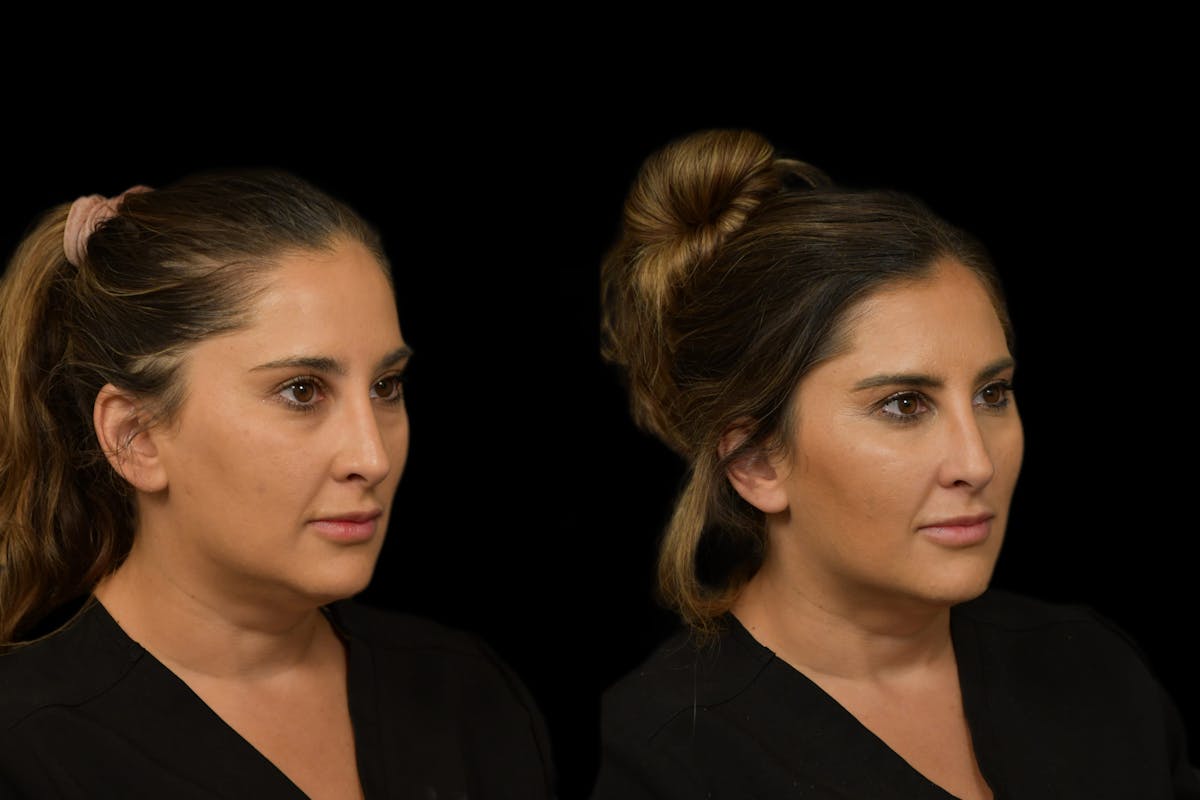 Under Eyes Before & After Gallery - Patient 129403 - Image 5