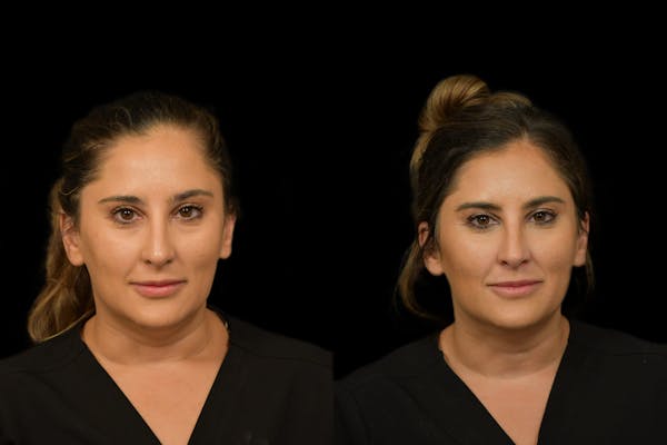 Injectables Before & After Gallery - Patient 396162 - Image 1